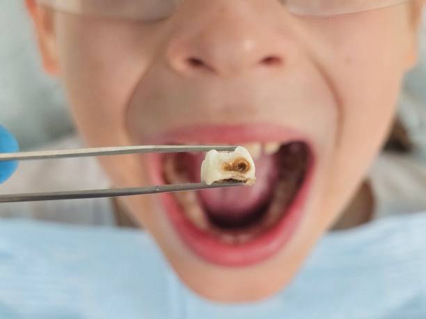 Best Urgent Tooth Repair  in Blue Ridge, GA